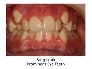 Fang Look Prominent Eye Teeth - Phase Two Ortho