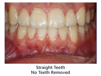 Straight Teeth No Teeth Removed - Phase Two Ortho