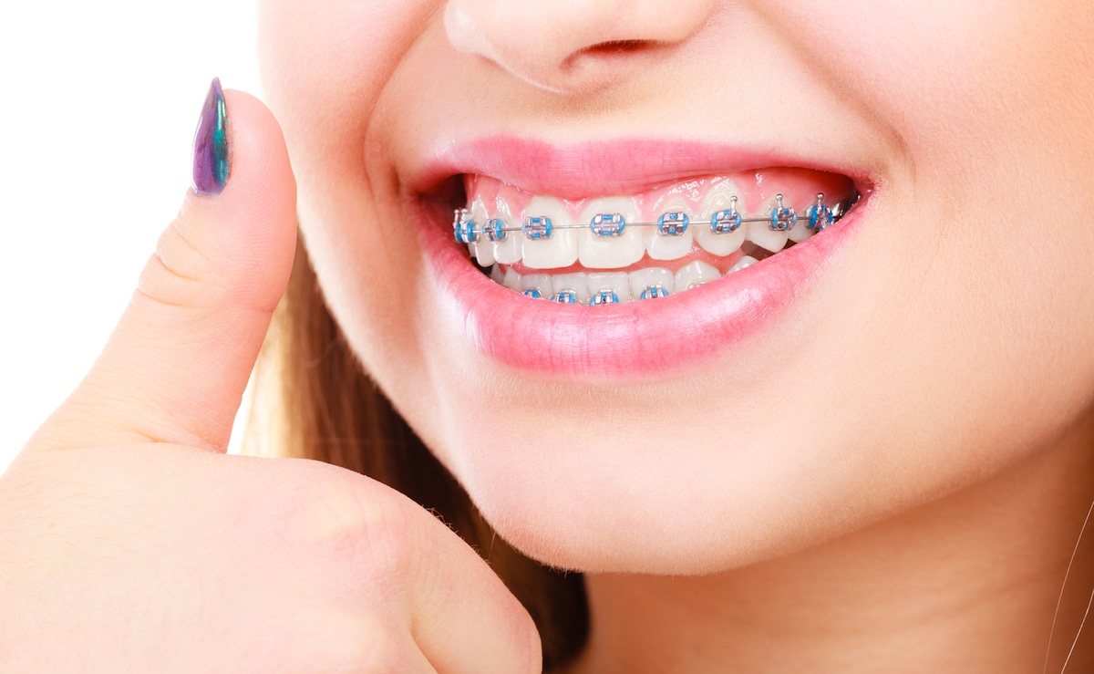 Orthodontics London Ontario - Rondeau Associates 1200