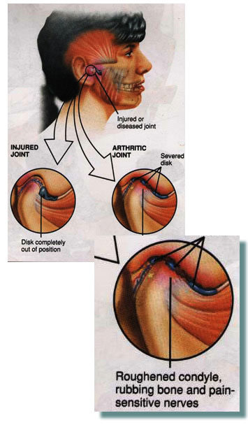 degenerative Jaw joint disease TMJ London On Rondeau