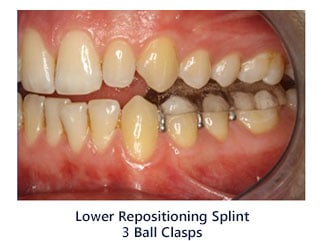 TMJ TMD Overview Consult at Dr. Brock Rondeau Associates