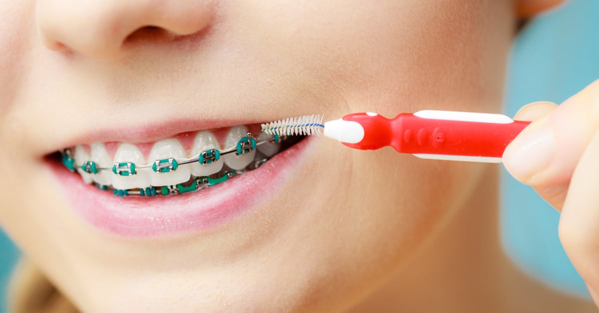 Can My Child Take Care Of Braces 5 Braces Maintenance Tips Dr Brock